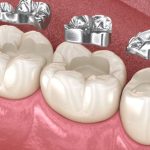 the ultimate guide to choosing the right dental filling material