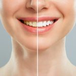 Teeth Whitening Results