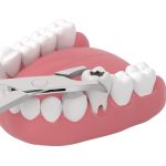 what to expect after a tooth extraction procedure